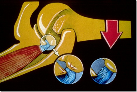 internal impingement internal impingement
